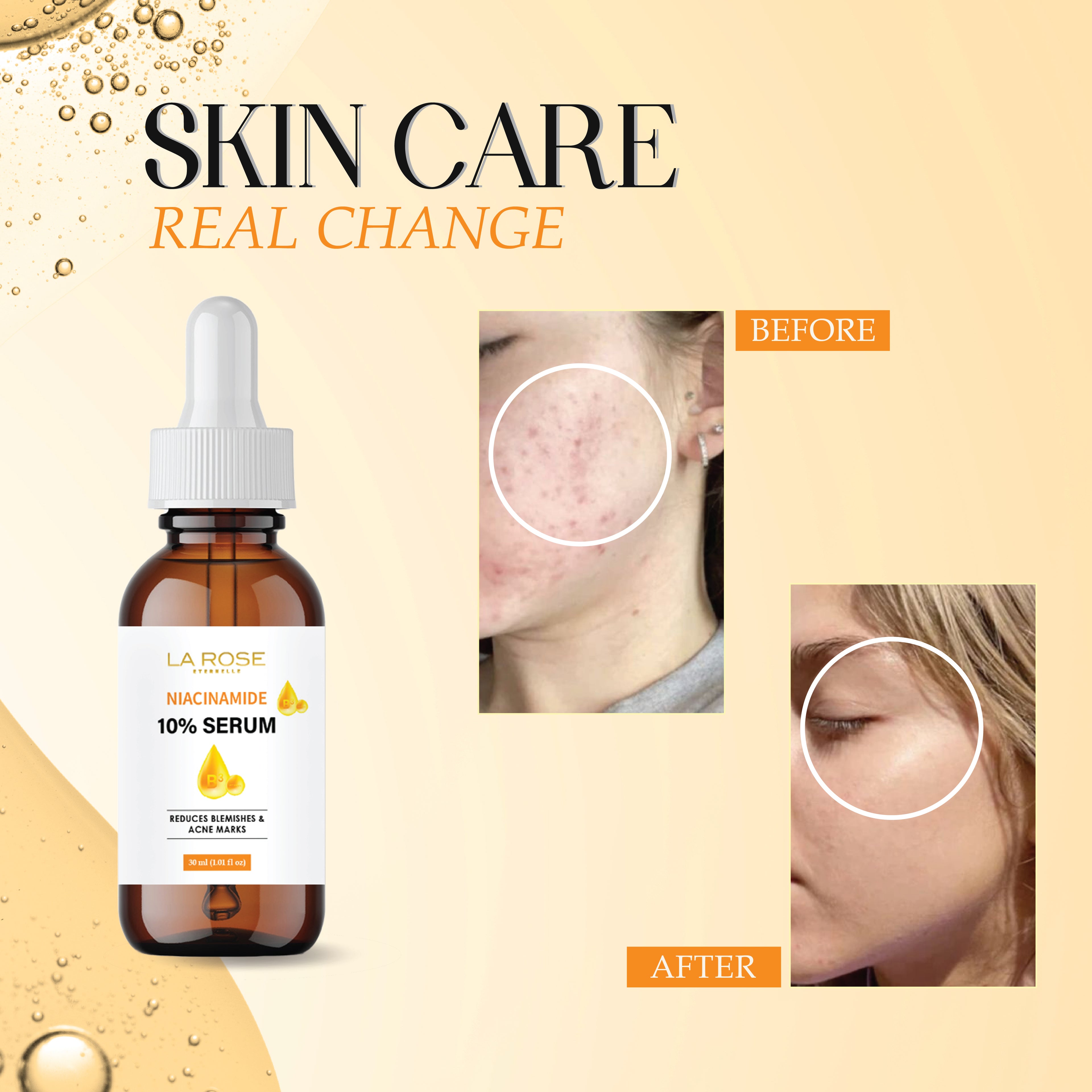 LA ROSE ETERNELLE Niacinamide 10% Serum, Reduces Blemishes and Acne Marks, 30 ml