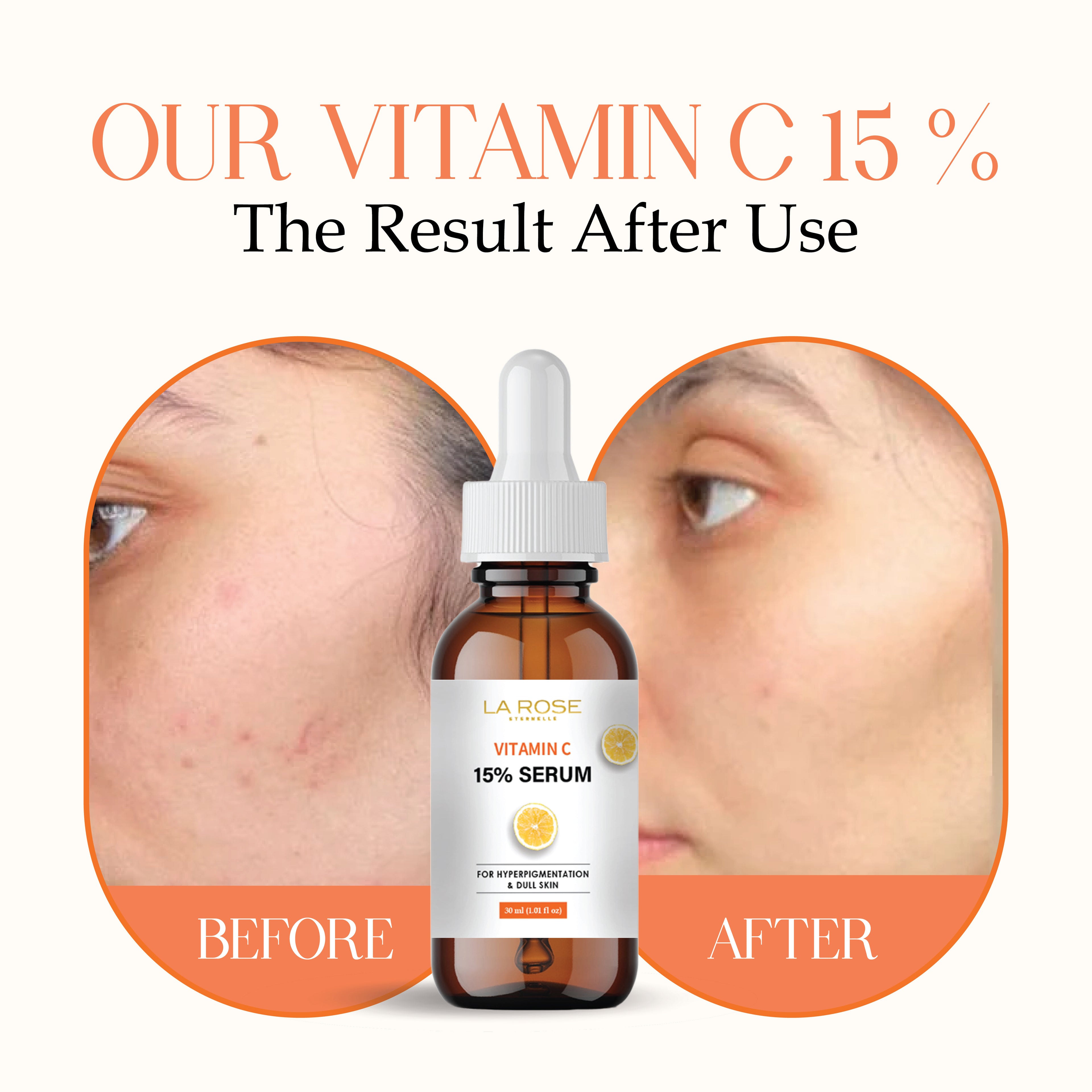 LA ROSE ETERNELLE Vitamin C 15% Serum for Hyperpigmentation and Dull Skin, 30ml